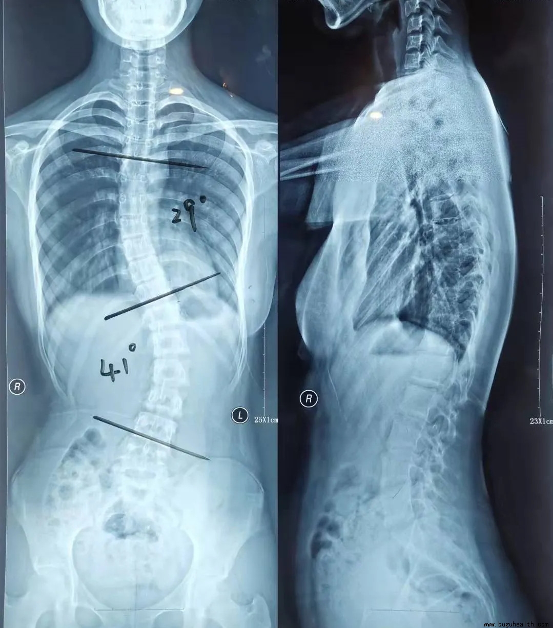 人体脊椎正常的曲度-图库-五毛网