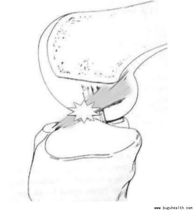 布骨医学科普、肌骨康复、布骨康复 布骨医学科普、肌骨康复、布骨康复