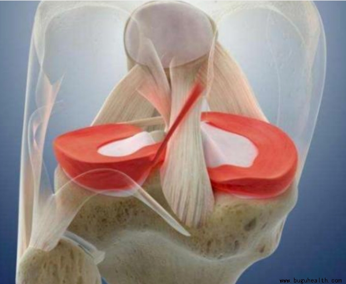 布骨医学科普、半月板术后、布骨康复 布骨医学科普、半月板术后、布骨康复