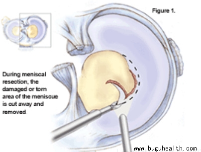 布骨医学科普、半月板术后、布骨康复 布骨医学科普、半月板术后、布骨康复