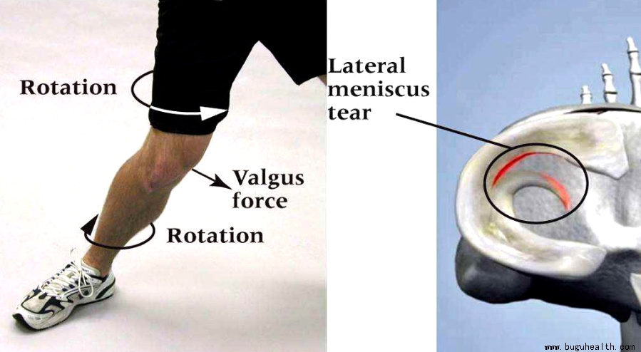 布骨医学科普、半月板术后、布骨康复 布骨医学科普、半月板术后、布骨康复