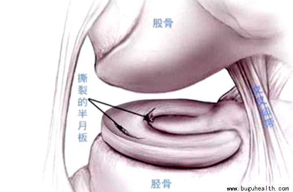布骨医学科普、半月板术后、布骨康复 布骨医学科普、半月板术后、布骨康复