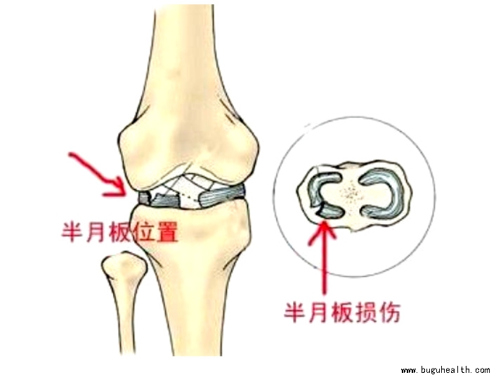 布骨医学科普、肌骨康复、布骨康复 布骨医学科普、肌骨康复、布骨康复