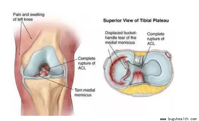 布骨医学科普、肌骨康复、布骨康复 布骨医学科普、肌骨康复、布骨康复